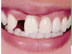 种牙后就能随意咬硬物?种植牙的误区必看