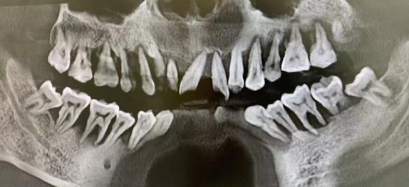 牙周自测｜你的牙周健康吗？