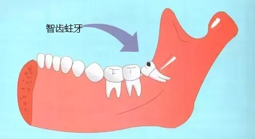 智齿发炎怎么办