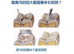 烟台口腔说说给宝宝做窝沟封闭的4个好时机