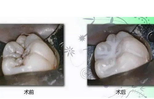 烟台口腔门诊说说给宝宝做窝沟封闭的时机