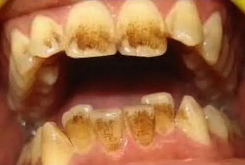 烟台口腔牙又黑又黄可以逆转