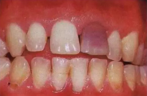 烟台口腔—牙又黑又黄可以逆转