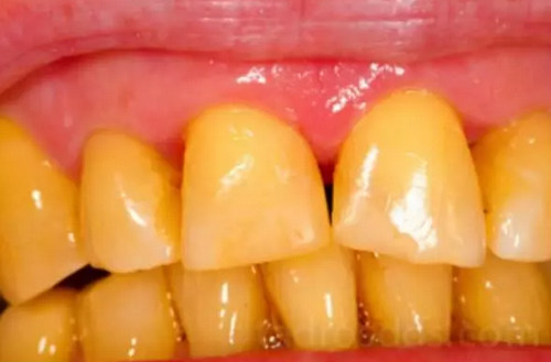 牙又黑又黄可以逆转