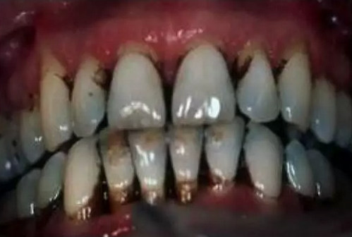 烟台口腔美白烟草