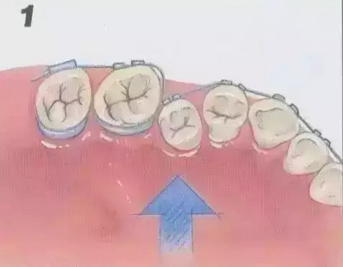 烟台隐形矫正时间是想缩短就能缩短的