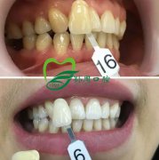 节前牙齿要美白,漂漂亮亮过个年！