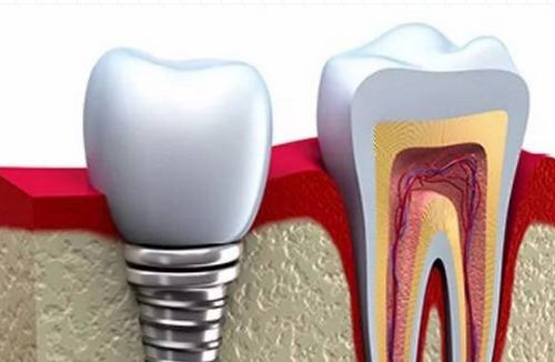 烟台种植牙科普知识-术后护理