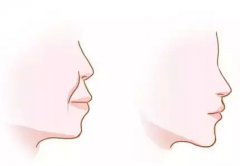 因意识不够,耽误孩子颜值烟台隐形矫正