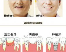 喜迎9.20爱牙日,孙周口腔种植牙感恩大回馈啦!