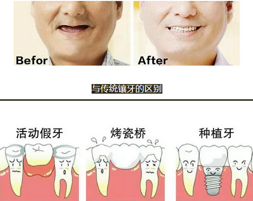烟台种植牙效果