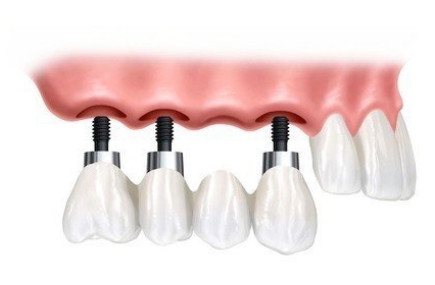 种植牙的价格由哪些因素决定