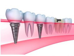 种植牙和镶牙的区别？