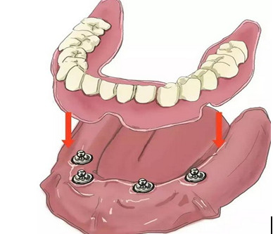 烟台种植牙和镶牙的区别