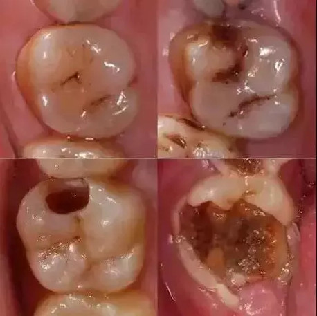 牙病拖延症，你越拖越花钱!