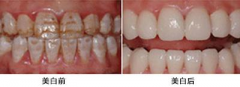 氟斑牙美白多少钱