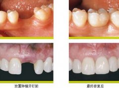 种植牙寿命有多长