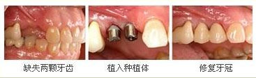 烟台种植牙多少钱