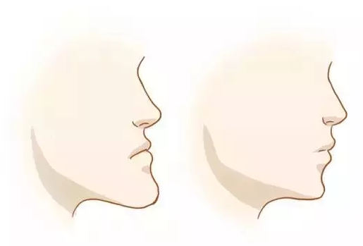 矫正牙齿，可以变得多好看?