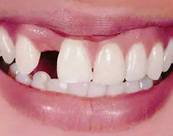 拔除牙齿后多久可以种植牙齿