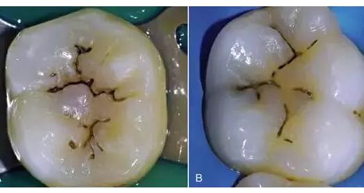 牙齿上有黑线，就一定是蛀牙吗？