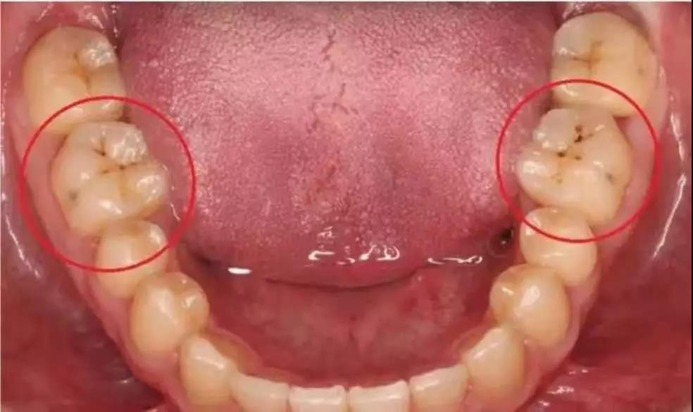 喂，你牙上有小黑斑吗？